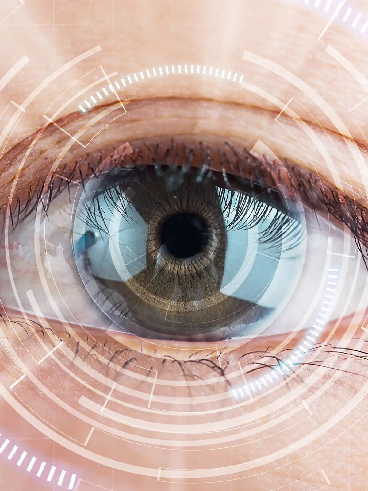 Ally laser cataract eye surgery