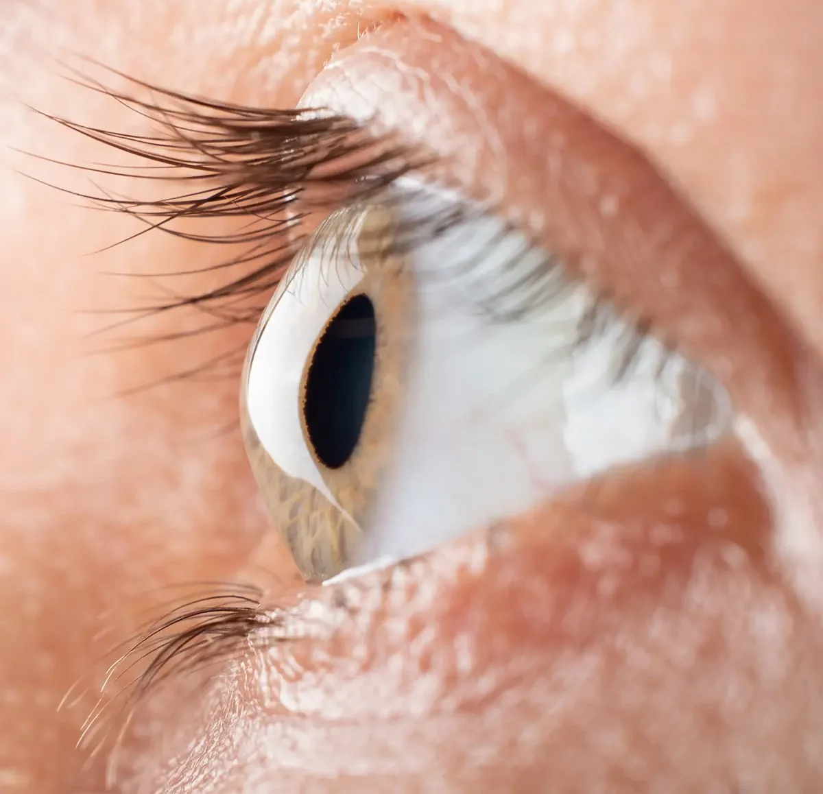 keratoconus eye corneal thinning